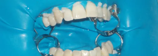 Diploma de Especialización en Técnicas de Blanqueamiento Dental 17ª Edición