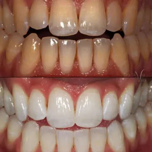 Blanqueamiento Dental Clínico: Protocolos y estrategia de equipo entre odontólogo e higienista (2027)