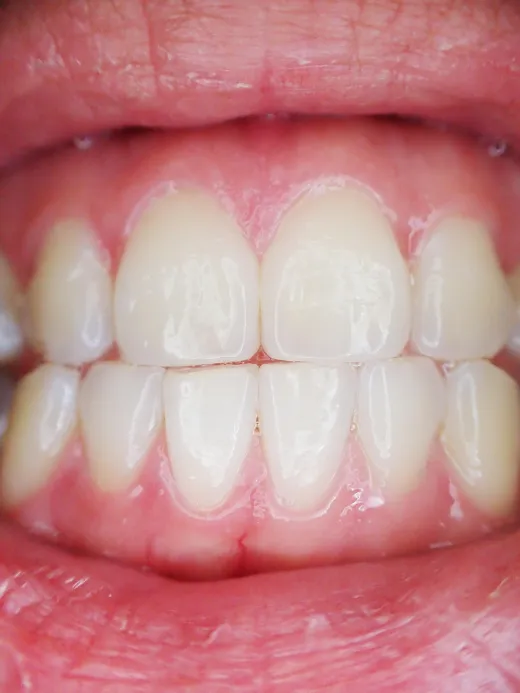 TRAUMATISMO DENTAL EN NIÑOS Y ADULTOS