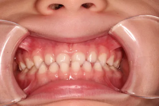 Ortodoncia interceptiva, RNO y miofuncional: crecimiento craneofacial en niños