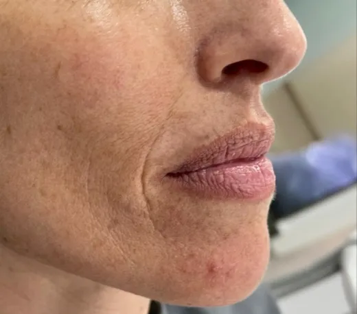 Intensivo de estética facial del tercio inferior: armonización orofacial