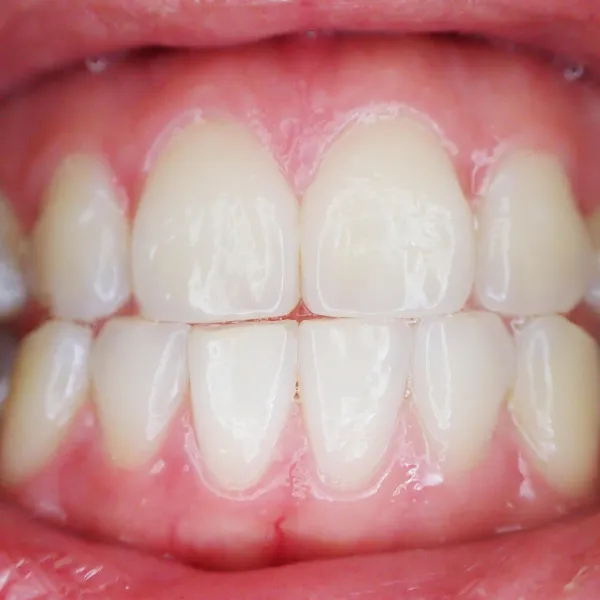 TRAUMATISMO DENTAL EN NIÑOS Y ADULTOS