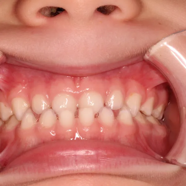 Ortodoncia interceptiva, RNO y miofuncional: crecimiento craneofacial en niños