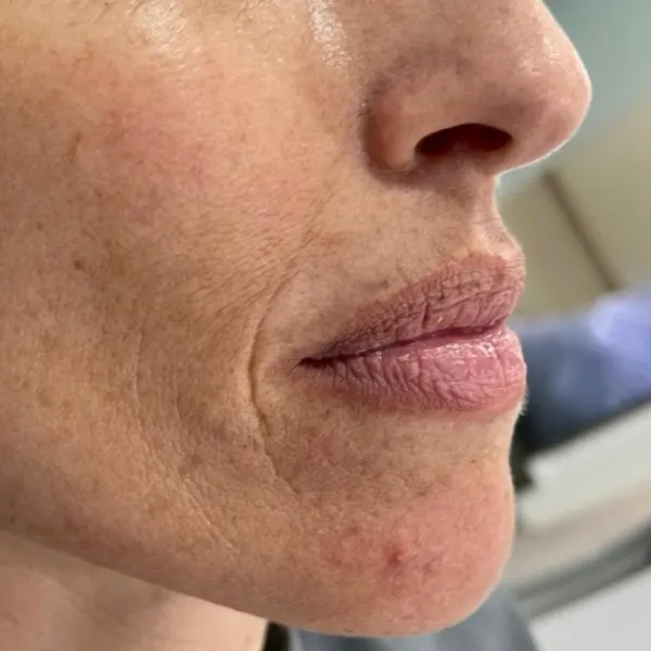 Intensivo de estética facial del tercio inferior: armonización orofacial