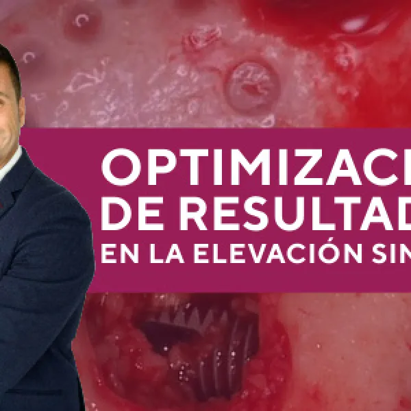 Optimización de resultados en la elevación sinusal: paso a paso
